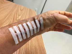 Steri-Strips before the pink cast.